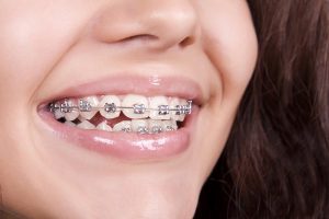 Tips to select the very best Dental Brace To Satisfy Your Needs