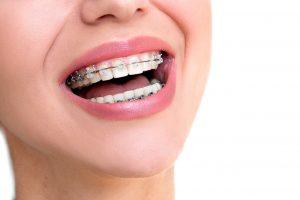 5 Teeth Straightening Options to Improve Your Smile: What to Consider?